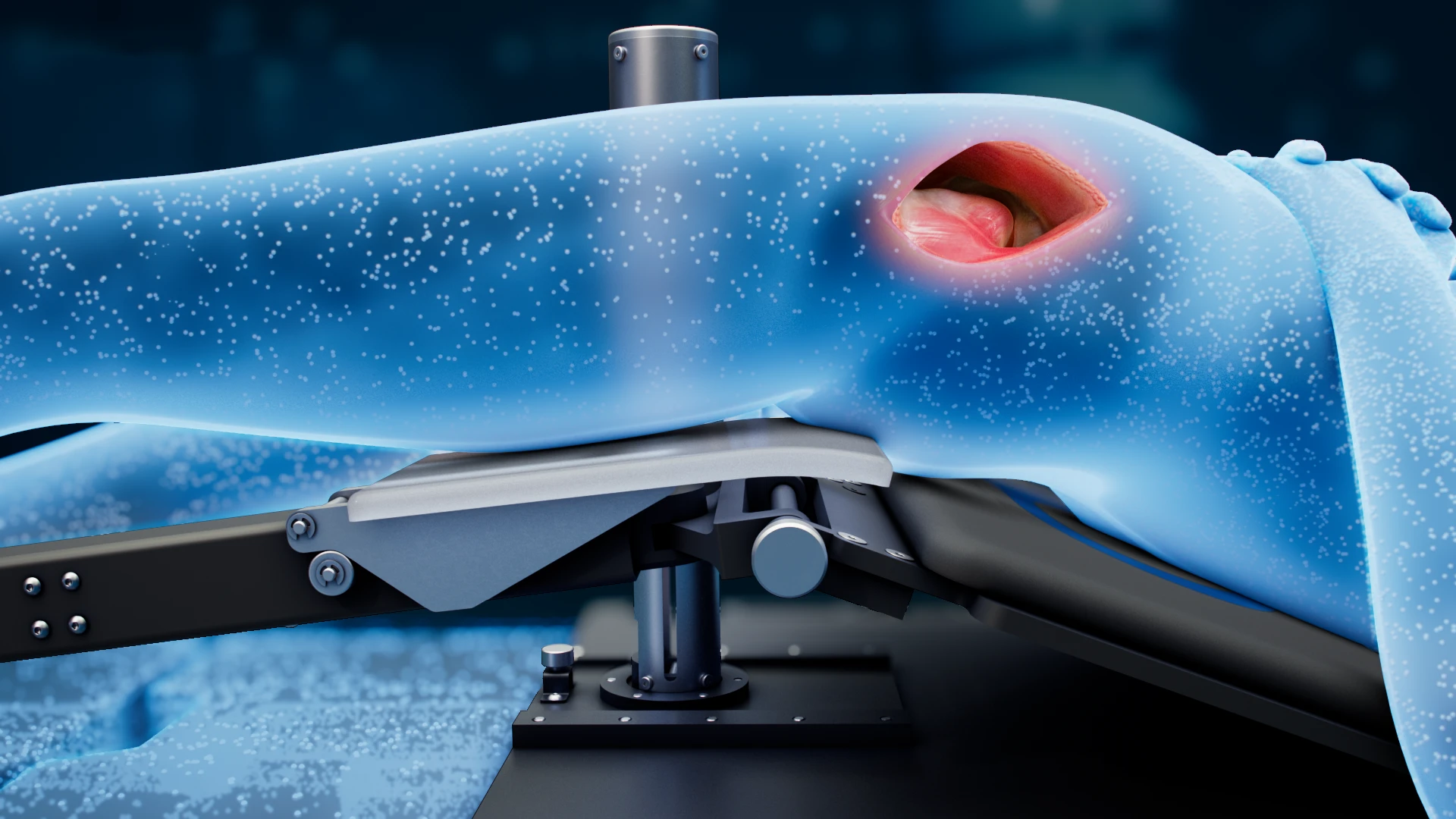 Dominion Patient Positioning System (PPS) Surgeon-directed positioning during anterior hip procedures